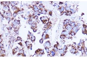 Immunohistochemistry of paraffin-embedded Human liver cancer using SHMT2 Polyclonal Antibody at dilution of 1:100 (40x lens). (SHMT2 anticorps)