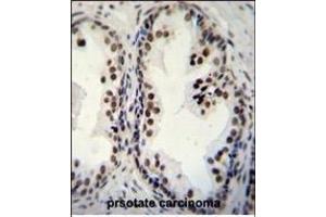 DDX27 Antibody (C-term) (ABIN655057 and ABIN2844686) immunohistochemistry analysis in formalin fixed and paraffin embedded human prsotate carcinoma followed by peroxidase conjugation of the secondary antibody and DAB staining. (DDX27 anticorps  (C-Term))