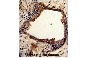 Formalin-fixed and paraffin-embedded human prostate carcinoma with NDRG1 Antibody (N-term), which was peroxidase-conjugated to the secondary antibody, followed by DAB staining.