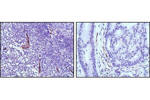 Immunohistochemical analysis of paraffin-embedded human lymph node (left) and colon cancer (right) tissues using eNOS antibody with DAB staining. (ENOS anticorps)