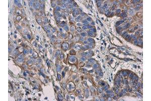 IHC-P Image IL3 Receptor alpha antibody [N2C2], Internal detects IL3 Receptor alpha protein at cell membrane and cytoplasm in human esophageal cancer by immunohistochemical analysis. (IL3RA anticorps)