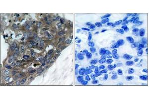 Immunohistochemical analysis of paraffin-embedded human breast carcinoma tissue, using ASK1 (Ab-966) antibody (E021134). (ASK1 anticorps)