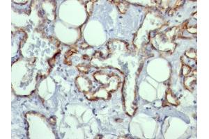 Formalin-fixed, paraffin-embedded human Angiosarcoma stained with CD31 Mouse Monoclonal Antibody (C31. (CD31 anticorps)