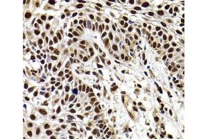 Immunohistochemistry of paraffin-embedded Human well-differentiated squamous skin carcinoma using HIRIP3 Polyclonal Antibody at dilution of 1:100 (40x lens). (HIRIP3 anticorps)