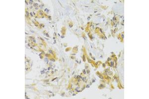 Immunohistochemistry of paraffin-embedded human breast cancer using EIF4G1 Antibody. (EIF4G1 anticorps)