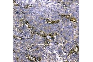 IHC testing of FFPE human lung cancer tissue with MYBPC3 antibody at 1ug/ml. (MYBPC3 anticorps)