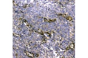 IHC testing of FFPE human lung cancer tissue with MYBPC3 antibody at 1ug/ml.