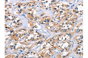 The image on the left is immunohistochemistry of paraffin-embedded Human thyroid cancer tissue using ABIN7189861(APOL6 Antibody) at dilution 1/50, on the right is treated with synthetic peptide. (APOL6 anticorps)