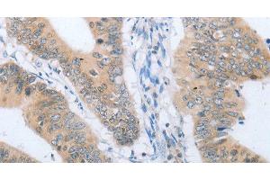 Immunohistochemistry of paraffin-embedded Human colon cancer tissue using CHRNA10 Polyclonal Antibody at dilution 1:50 (CHRNA10 anticorps)