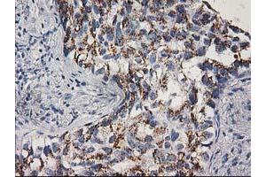 Immunohistochemical staining of paraffin-embedded Carcinoma of Human lung tissue using anti-CDK2 mouse monoclonal antibody. (CDK2 anticorps)
