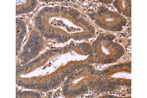 Immunohistochemistry of Human cervical cancer using CDC37L1 Polyclonal Antibody at dilution of 1:50 (CDC37L1 anticorps)
