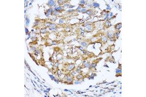 Immunohistochemistry of paraffin-embedded human breast cancer using NDE1 antibody. (NDE1 anticorps  (AA 1-110))