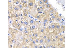 Immunohistochemistry of paraffin-embedded Human liver cancer using CRK Polyclonal Antibody at dilution of 1:200 (40x lens). (Crk anticorps)
