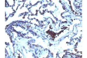 IHC testing of FFPE human lung carcinoma with TDP2 antibody (clone TDP2/1258). (TDP2 anticorps)