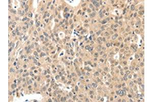 The image on the left is immunohistochemistry of paraffin-embedded Human ovarian cancer tissue using ABIN7192211(ROS1 Antibody) at dilution 1/40, on the right is treated with synthetic peptide. (ROS1 anticorps)