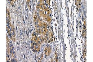 ABIN7097100 and ABIN7101167 at 1/100 staining human esophageal cancer and adjacent non-tumor tissue by IHC-P. (COQ3 anticorps)