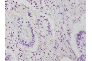 Immunohistochemistry of paraffin-embedded human colon cancer using ABIN7142748 at dilution of 1:25 (RPL14 anticorps  (AA 2-214))