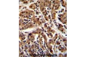 AKT1 Antibody (C-term T450) immunohistochemistry analysis in formalin fixed and paraffin embedded human breast carcinoma followed by peroxidase conjugation of the secondary antibody and DAB staining. (AKT1 anticorps  (C-Term))