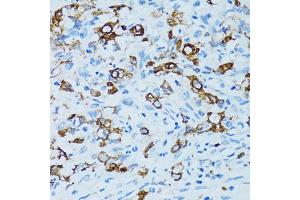 Immunohistochemistry of paraffin-embedded human uterine cancer using CTSE antibody. (Cathepsin E anticorps)