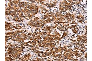 The image on the left is immunohistochemistry of paraffin-embedded Human breast cancer tissue using ABIN7192115(Rab3D Antibody) at dilution 1/27, on the right is treated with synthetic peptide.