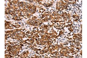 The image on the left is immunohistochemistry of paraffin-embedded Human breast cancer tissue using ABIN7192115(Rab3D Antibody) at dilution 1/27, on the right is treated with synthetic peptide. (RAB3D anticorps)