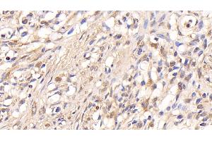 Detection of AMPK Alpha 1 in Human Ovarian cancer Tissue using Polyclonal Antibody to Protein Kinase, AMP Activated Alpha 1 (AMPK Alpha 1)
