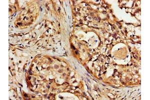 IHC image of ABIN7170140 diluted at 1:200 and staining in paraffin-embedded human cervical cancer performed on a Leica BondTM system.