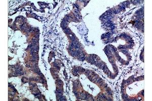 Immunohistochemical analysis of paraffin-embedded Human-colon-cancer, antibody was diluted at 1:100 (IL17F anticorps  (AA 81-130))