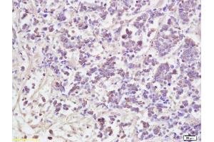 Formalin-fixed and paraffin embedded human lung carcinoma labeled with Anti AATF Polyclonal Antibody, Unconjugated (ABIN673689) at 1:200 followed by conjugation to the secondary antibody and DAB staining