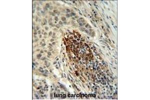MF Antibody (C-term) 940b IHC analysis in formalin fixed and paraffin embedded human lung carcinoma followed by peroxidase conjugation of the secondary antibody and DAB staining. (MFAP4 anticorps  (C-Term))