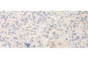 Immunohistochemistry of paraffin-embedded Human cervical cancer tissue using TUBG2 Polyclonal Antibody at dilution of 1:50(x200) (TUBG2 anticorps)