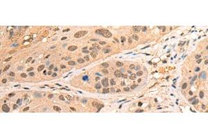 Immunohistochemistry of paraffin-embedded Human esophagus cancer tissue using BPGM Polyclonal Antibody at dilution of 1:70(x200) (BPGM anticorps)