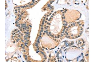 The image on the left is immunohistochemistry of paraffin-embedded Human thyroid cancer tissue using ABIN7130823(RASGEF1A Antibody) at dilution 1/20, on the right is treated with fusion protein.