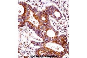 CEAC Antibody (Center) ((ABIN1537760 and ABIN2848792))immunohistochemistry analysis in formalin fixed and paraffin embedded human colon carcinoma followed by peroxidase conjugation of the secondary antibody and DAB staining. (CEACAM7 anticorps  (AA 112-140))