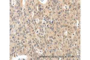 Immunohistochemistry of Human ovarian cancer using ROS1 Polyclonal Antibody at dilution of 1:40 (ROS1 anticorps)