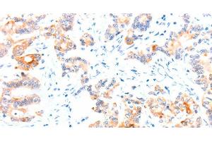Immunohistochemistry of paraffin-embedded Human colon cancer tissue using CCDC88A Polyclonal Antibody at dilution 1:50 (Girdin anticorps)