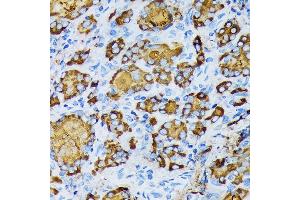 Immunohistochemistry of paraffin-embedded human thyroid cancer using γ-Tubulin Rabbit mAb (ABIN7271052) at dilution of 1:100 (40x lens). (TUBG1 anticorps)