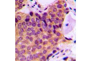 Immunohistochemical analysis of JNK1/2/3 (pT183) staining in human breast cancer formalin fixed paraffin embedded tissue section.