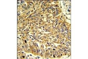 Formalin-fixed and paraffin-embedded human lung carcinoma reacted with RGP1 Antibody (C-term), which was peroxidase-conjugated to the secondary antibody, followed by DAB staining. (RGP1 anticorps  (C-Term))