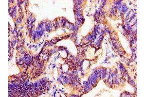 Immunohistochemistry of paraffin-embedded human colon cancer using ABIN7162750 at dilution of 1:100 (PTX3 anticorps  (AA 99-164))