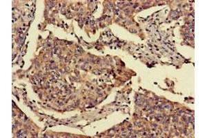 Immunohistochemistry of paraffin-embedded human cervical cancer using ABIN7153070 at dilution of 1:100 (FOXN1 anticorps  (AA 1-160))