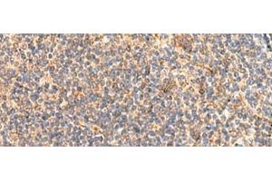 Immunohistochemistry of paraffin-embedded Human tonsil tissue using ABHD2 Polyclonal Antibody at dilution of 1:40(x200) (ABHD2 anticorps)