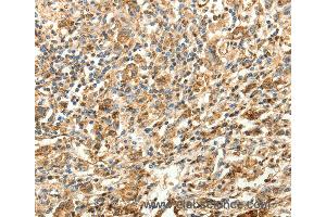 Immunohistochemistry of Human gastric cancer using SLC25A11 Polyclonal Antibody at dilution of 1:30 (SLC25A11 anticorps)
