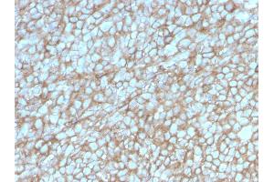 Formalin-fixed, paraffin-embedded human Melanoma stained with MCAM Mouse Monoclonal Antibody (MCAM/3048).
