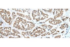Immunohistochemistry of paraffin-embedded Human esophagus cancer tissue using ZNF248 Polyclonal Antibody at dilution of 1:25(x200) (ZNF248 anticorps)