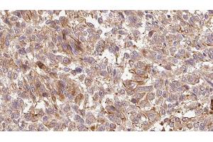 ABIN6279251 at 1/100 staining Human Melanoma tissue by IHC-P. (CPA6 anticorps  (Internal Region))