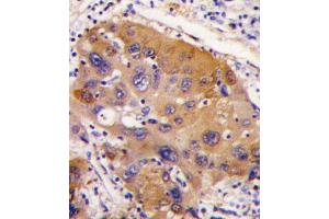 Formalin-fixed and paraffin-embedded human hepatocarcinoma tissue reacted with NNMT antibody (Center) (ABIN387867 and ABIN2844050) , which was peroxidase-conjugated to the secondary antibody, followed by DAB staining. (NNMT anticorps  (AA 77-106))