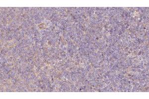 ABIN6273066 at 1/100 staining Human lymph cancer tissue by IHC-P. (PPPDE1 anticorps  (Internal Region))