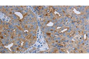 Immunohistochemistry of paraffin-embedded Human ovarian cancer using SLC34A2 Polyclonal Antibody at dilution of 1:50