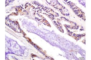 Formalin-fixed and paraffin embedded human colon carcinoma labeled with Anti-P21 Polyclonal Antibody, Unconjugated (ABIN1714474) at 1:200 followed by conjugation to the secondary antibody and DAB staining (p21 anticorps  (AA 21-100))